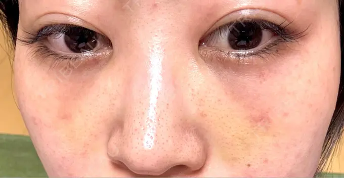 クマ治療 / ヒアルロン酸注入（目の下） 仙台N美容クリニック DAY 8 メイン用