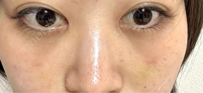 クマ治療 / ヒアルロン酸注入（目の下） 仙台N美容クリニック DAY 9 メイン用