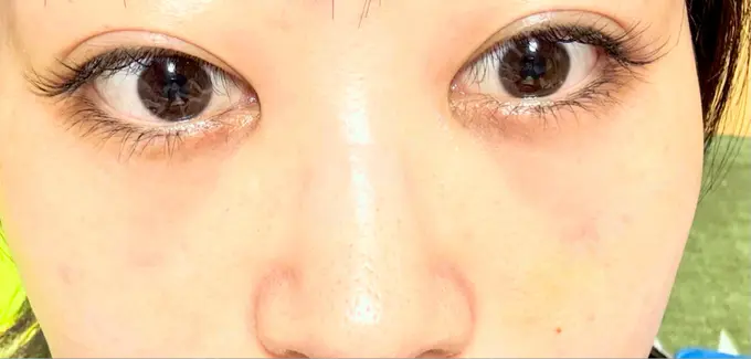 クマ治療 / ヒアルロン酸注入（目の下） 仙台N美容クリニック DAY 10 メイン用