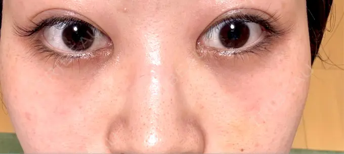 クマ治療 / ヒアルロン酸注入（目の下） 仙台N美容クリニック DAY 11 メイン用