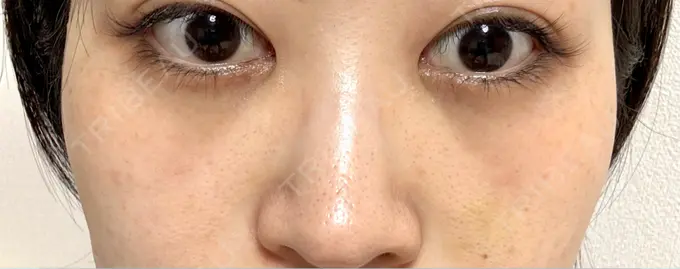 クマ治療 / ヒアルロン酸注入（目の下） 仙台N美容クリニック DAY 12 メイン用