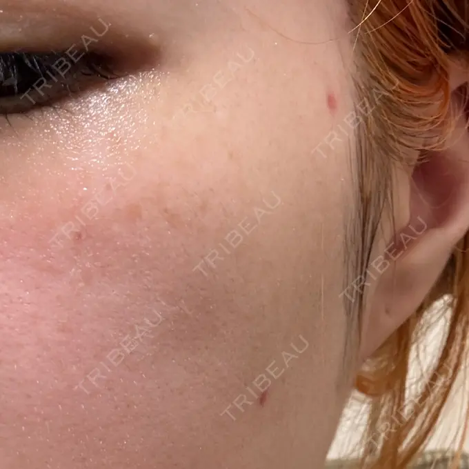 ほくろ・いぼ除去レーザー（肌） Mavie Beauty Clinic （マヴィービューティークリニック） DAY 10 メイン用