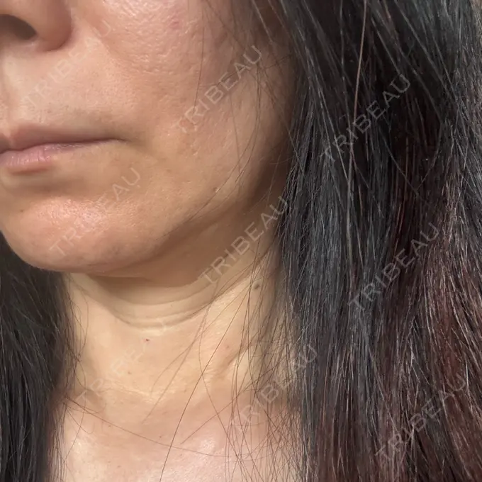 肌育注射（ジュベルックなど） Natural Skin Clinic 自由ヶ丘院 AFTER メイン用