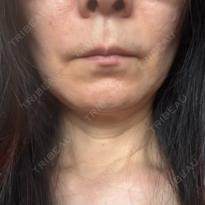 肌育注射（ジュベルックなど） Natural Skin Clinic 自由ヶ丘院 DAY 11 メイン用