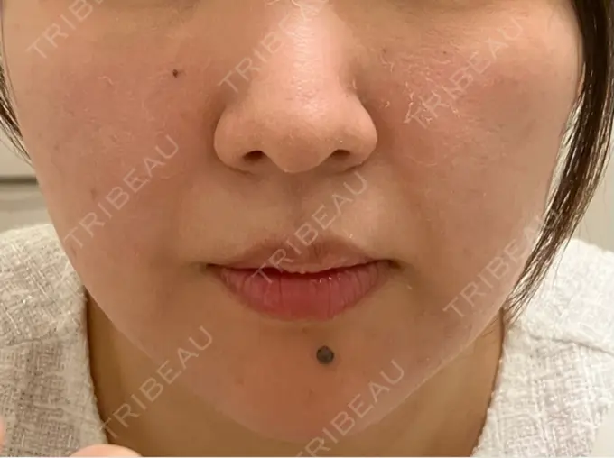 ピーリング（ニキビ・毛穴） / ピコレーザートーニング（美白・肝斑） / フラクショナルレーザー（毛穴・ニキビ跡） / ピコスポット BISIN GINZA CLINIC DAY 3 メイン用