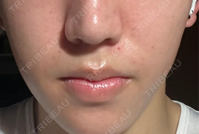 ボトックス（エラ・小顔） eクリニック 東京院 DAY 1 メイン用