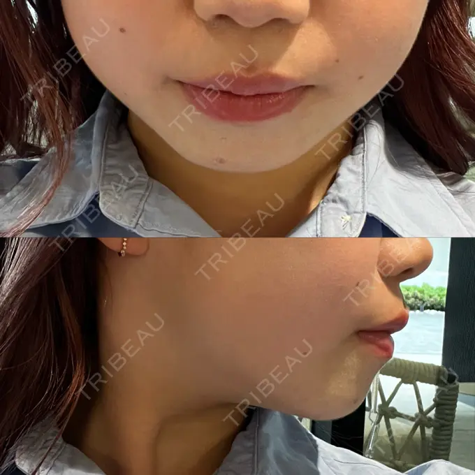 RF（高周波）たるみ治療 大美会クリニック 梅田院 AFTER メイン用