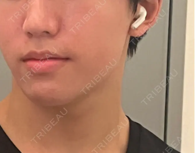 ボトックス（エラ・小顔） eクリニック 東京院 DAY 5 メイン用