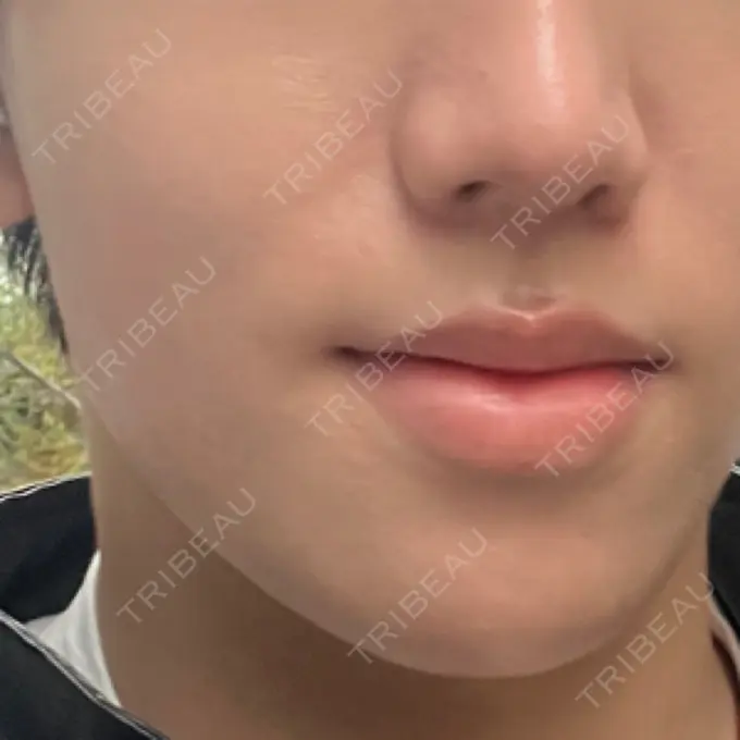 ボトックス（エラ・小顔） eクリニック 東京院 DAY 6 メイン用