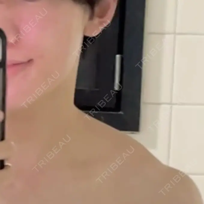 ボトックス（エラ・小顔） eクリニック 東京院 DAY 8 メイン用