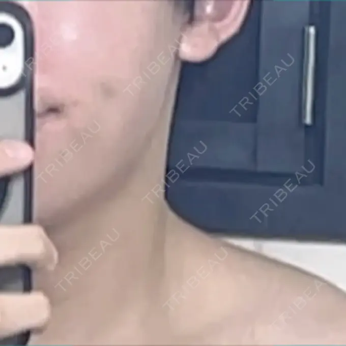 ボトックス（エラ・小顔） eクリニック 東京院 DAY 9 メイン用