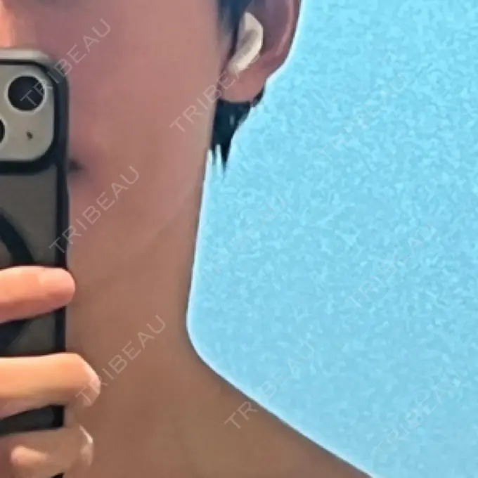 ボトックス（エラ・小顔） eクリニック 東京院 DAY 9 メイン用