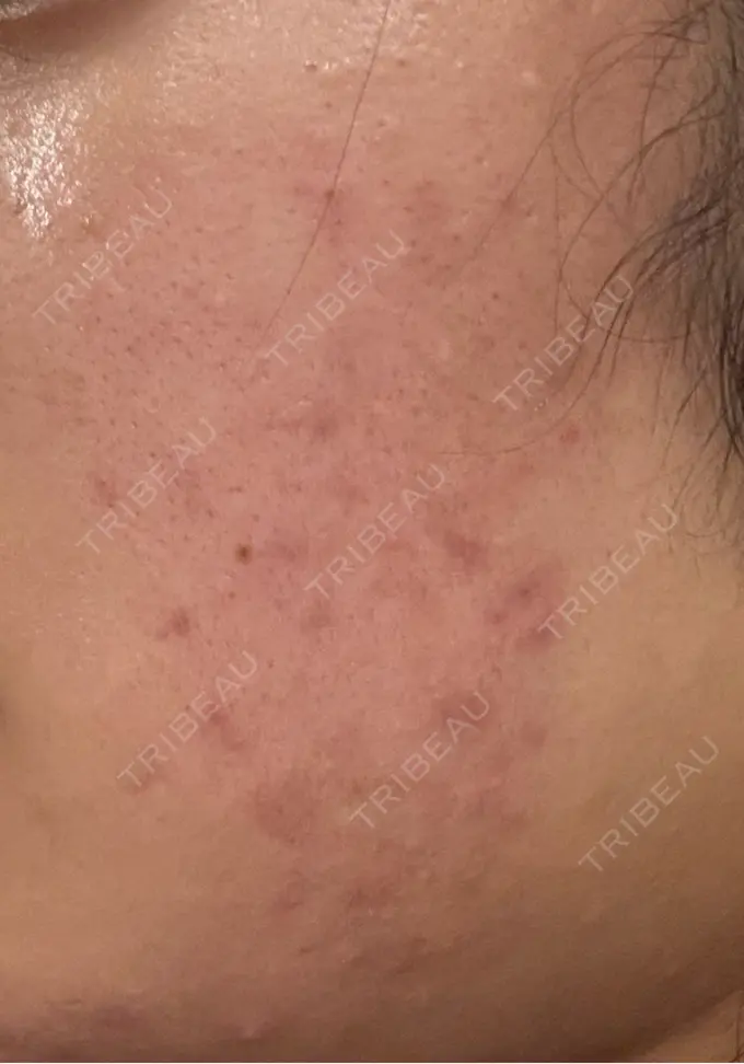 毛穴洗浄（ハイドラフェイシャルなど） / リジュラン 表参道ウィズ・クリニック DAY 1 メイン用