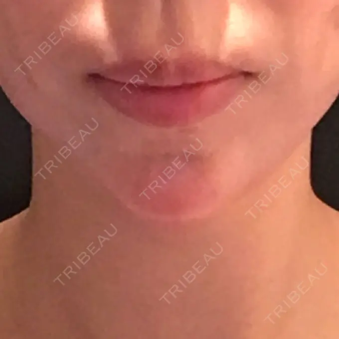 ヒアルロン酸注入（あご） ルラ美容クリニック 福岡本院 DAY 0 メイン用