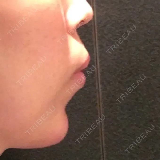 ヒアルロン酸注入（あご） ルラ美容クリニック 福岡本院 DAY 0 メイン用