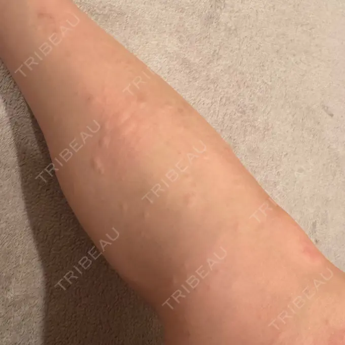 医療脱毛（全身） Grias clinic （ジリアスクリニック） AFTER メイン用