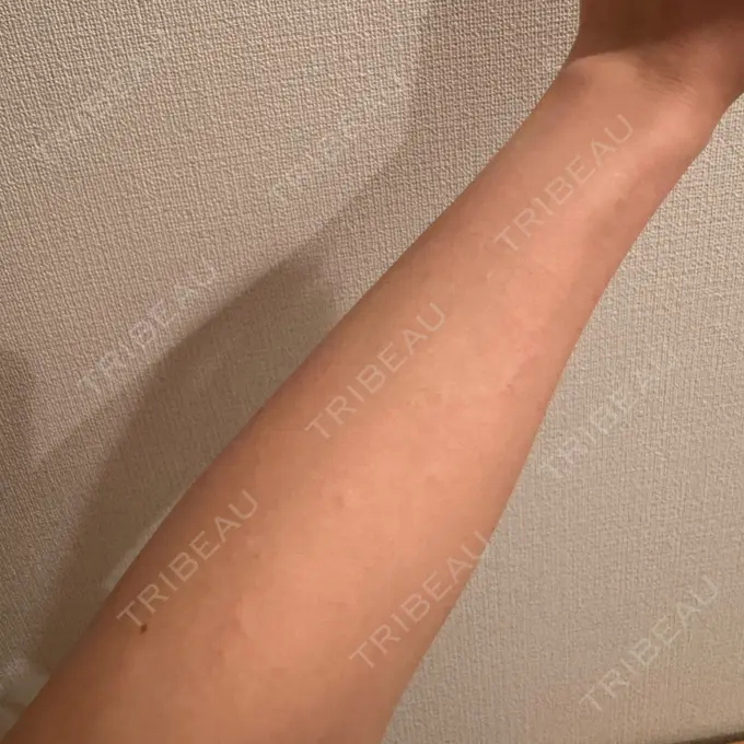 医療脱毛（全身） Grias clinic （ジリアスクリニック） DAY 0 メイン用