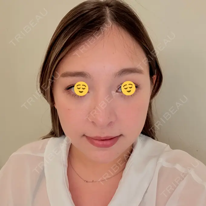 糸リフト / ヒアルロン酸注入（目の下） / RF（高周波）たるみ治療 gift clinic DAY 11 メイン用