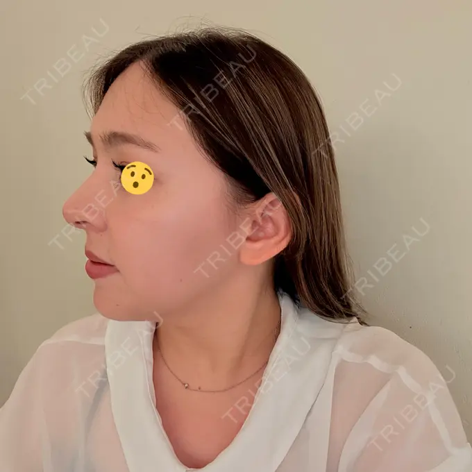 糸リフト / ヒアルロン酸注入（目の下） / RF（高周波）たるみ治療 gift clinic DAY 11 メイン用