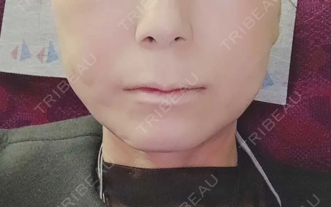 糸リフト / ボトックス（エラ・小顔） / ピーリング（ハリ・ツヤ） アリエル美容クリニック 横浜院 AFTER メイン用