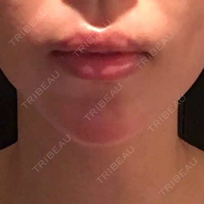 ヒアルロン酸注入（あご） ルラ美容クリニック 福岡本院 DAY 1 メイン用