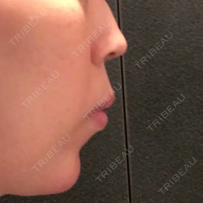 ヒアルロン酸注入（あご） ルラ美容クリニック 福岡本院 DAY 1 メイン用