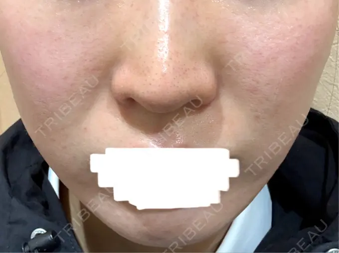 イオン導入 / シミ取りレーザー / ピコレーザートーニング（美白・肝斑） アモーレクリニック 名古屋院 DAY 38 メイン用