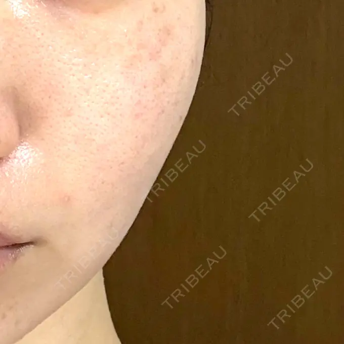 肌育注射（ジュベルックなど） / シミ取りレーザー / ピコレーザートーニング（美白・肝斑） / ピコフラクショナルレーザー（毛穴・ニキビ跡） 東京シルククリニック 新宿院 AFTER メイン用