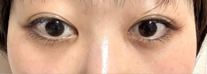 クマ治療 / ヒアルロン酸注入（目の下） 仙台N美容クリニック AFTER メイン用