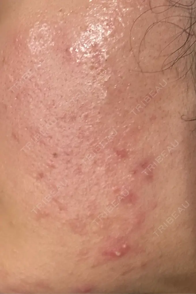 毛穴洗浄（ハイドラフェイシャルなど） / リジュラン 表参道ウィズ・クリニック DAY 3 メイン用