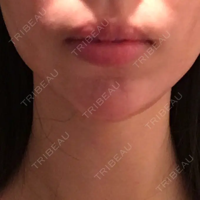 ヒアルロン酸注入（あご） ルラ美容クリニック 福岡本院 AFTER メイン用