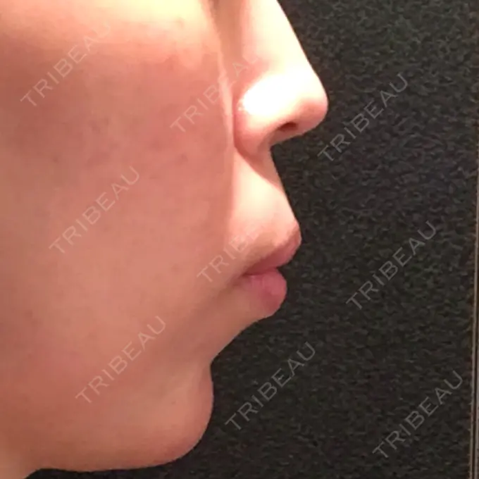 ヒアルロン酸注入（あご） ルラ美容クリニック 福岡本院 DAY 2 メイン用