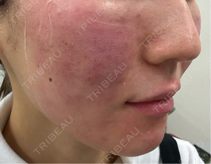 肌育注射（ジュベルックなど） 城本クリニック 池袋院 DAY 0 メイン用