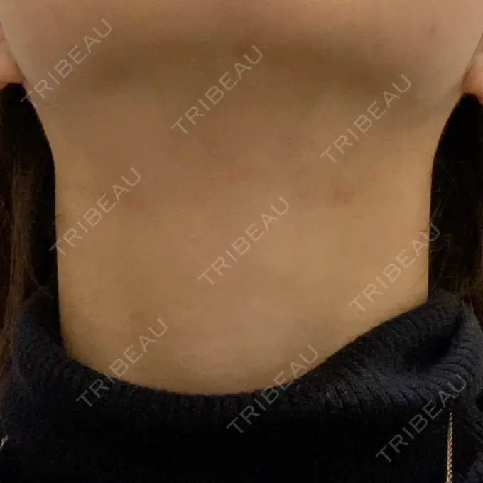 医療痩身（顔） / ボトックス（エラ・小顔） Chloe Cheongdam Clinic （クロエチョンダムクリニック） DAY 7 メイン用