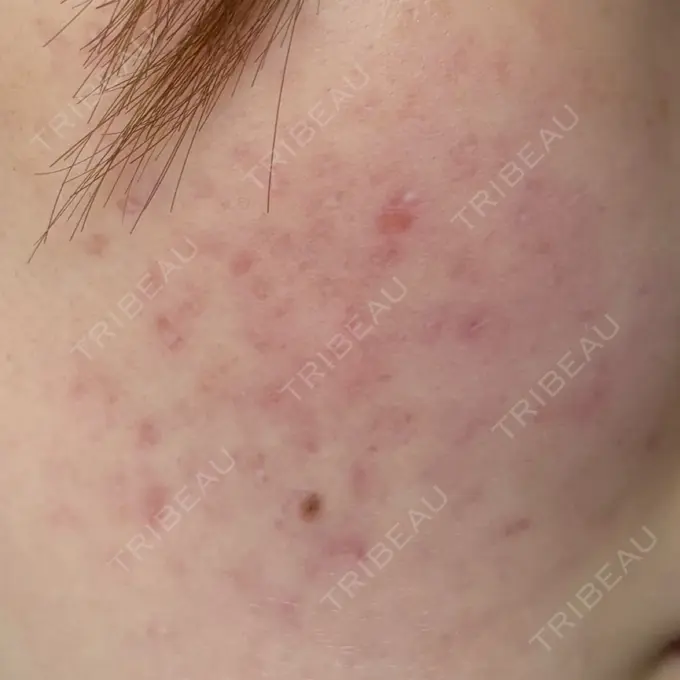 ピーリング（ニキビ・毛穴） / ルメッカ Grias clinic （ジリアスクリニック） DAY 0 メイン用