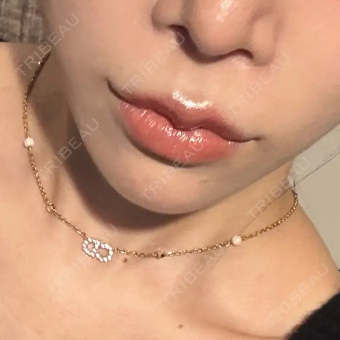 人中短縮 / 鼻翼挙上 / 鼻尖縮小 Otus Clinic 【オータスクリニック】 DAY 257 メイン用