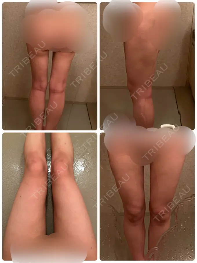 脂肪吸引（顔） / 脂肪吸引（脚） Mods Clinic（モッズクリニック） 名古屋院 DAY 180 メイン用