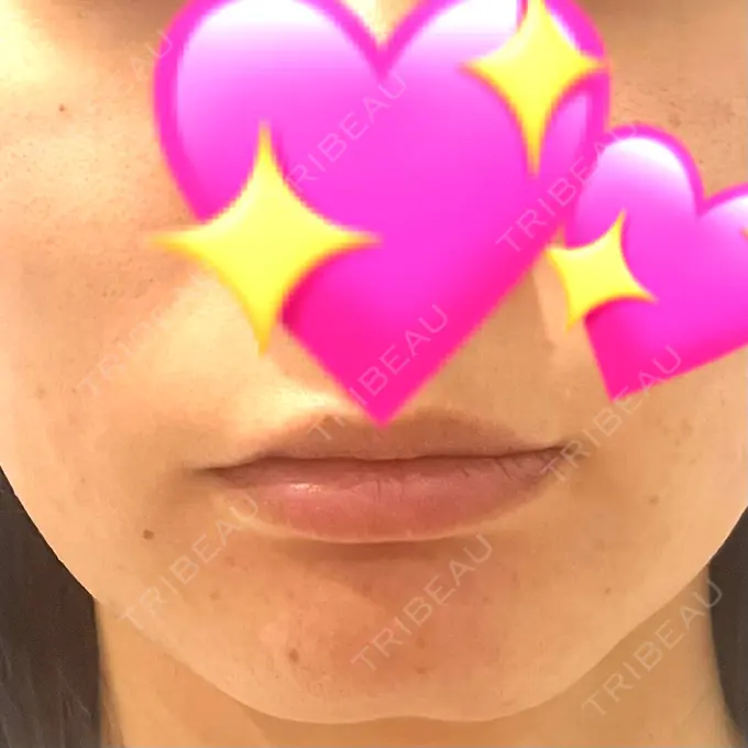 医療脱毛（顔） おおかみ美容のクリニック 横浜院 AFTER メイン用