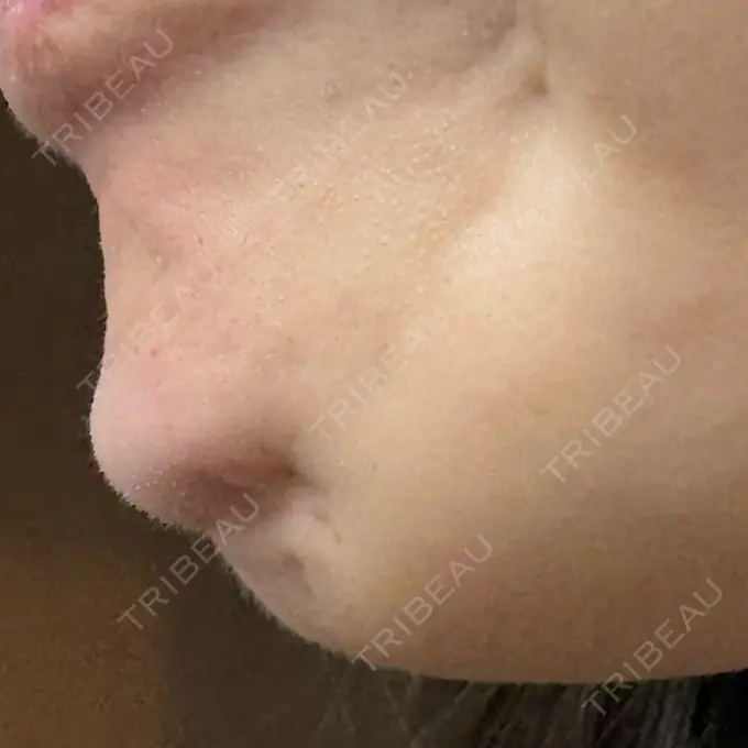 ボトックス（あご） / ボトックス（エラ・小顔） / ボトックス（額） TCB東京中央美容外科 青森院 DAY 1 メイン用