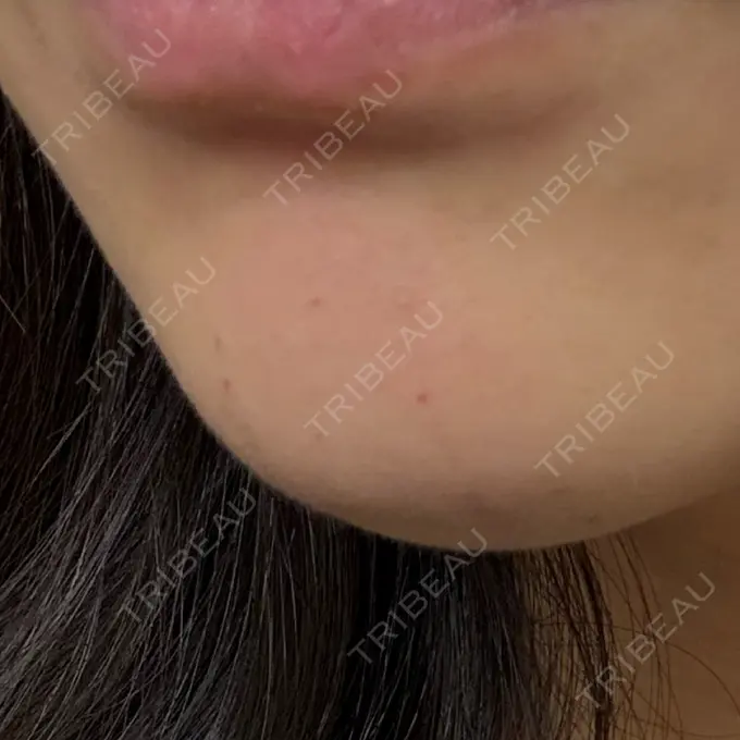 ボトックス（あご） / ボトックス（エラ・小顔） / ボトックス（額） TCB東京中央美容外科 青森院 DAY 1 メイン用