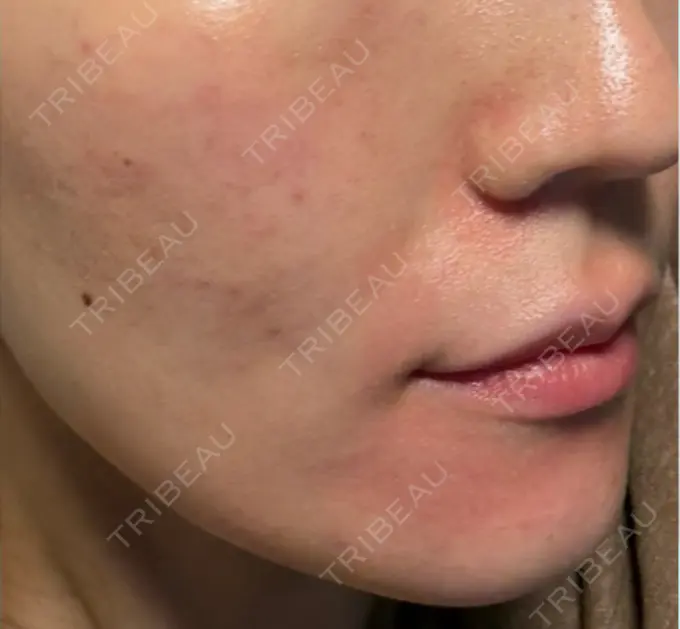 肌育注射（ジュベルックなど） 城本クリニック 池袋院 DAY 1 メイン用