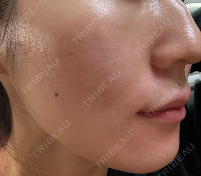 肌育注射（ジュベルックなど） 城本クリニック 池袋院 AFTER メイン用