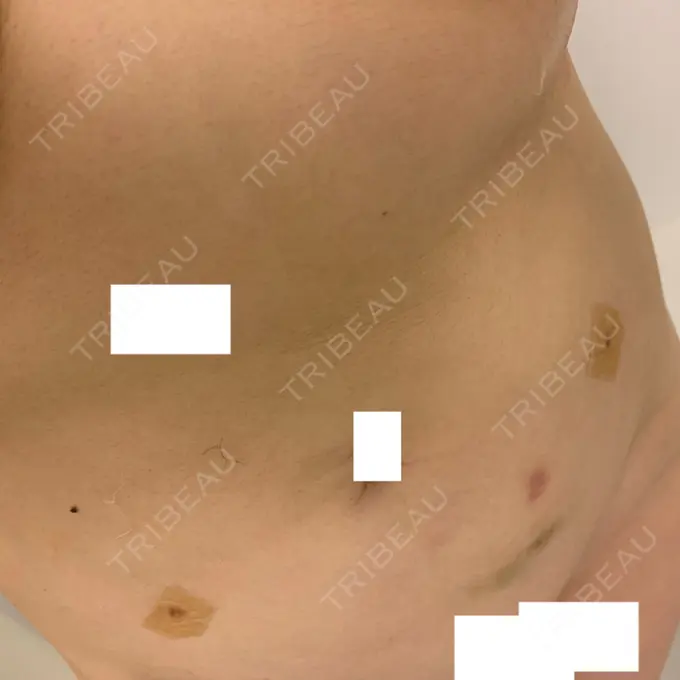 脂肪吸引（二の腕） / 脂肪吸引（お腹） / 脂肪溶解注射（二の腕） / 脂肪溶解注射（お腹） / その他（ボディ） THE SKINNY CLINIC（ザ・スキニークリニック） DAY 13 メイン用