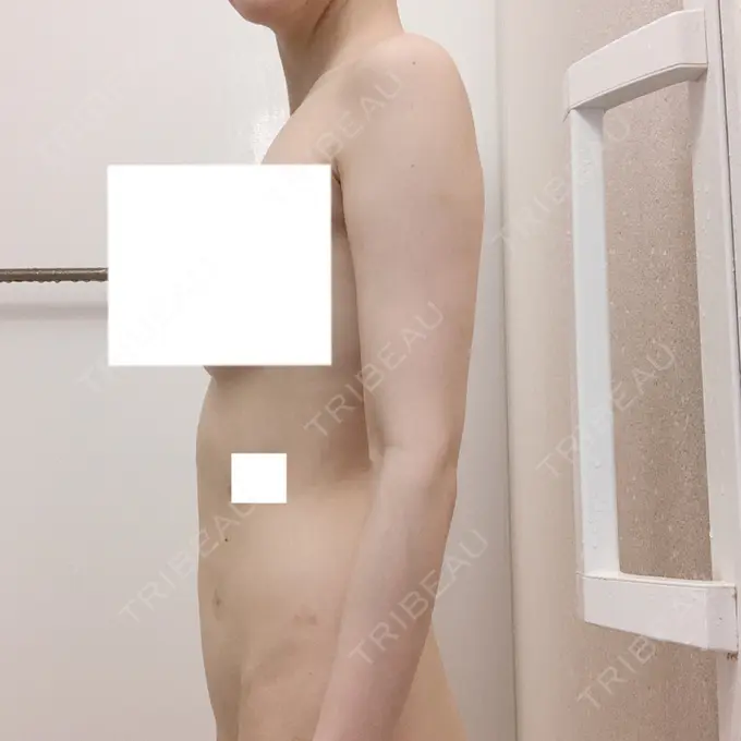 脂肪吸引（二の腕） / 脂肪吸引（お腹） / 脂肪溶解注射（二の腕） / 脂肪溶解注射（お腹） / その他（ボディ） THE SKINNY CLINIC（ザ・スキニークリニック） DAY 13 メイン用