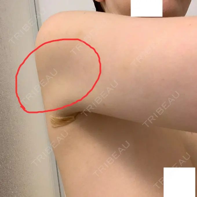 脂肪吸引（二の腕） / 脂肪吸引（お腹） / 脂肪溶解注射（二の腕） / 脂肪溶解注射（お腹） / その他（ボディ） THE SKINNY CLINIC（ザ・スキニークリニック） DAY 13 メイン用