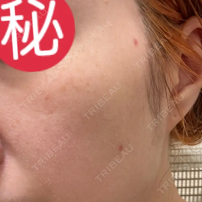 ほくろ・いぼ除去レーザー（肌） Mavie Beauty Clinic （マヴィービューティークリニック） DAY 15 メイン用