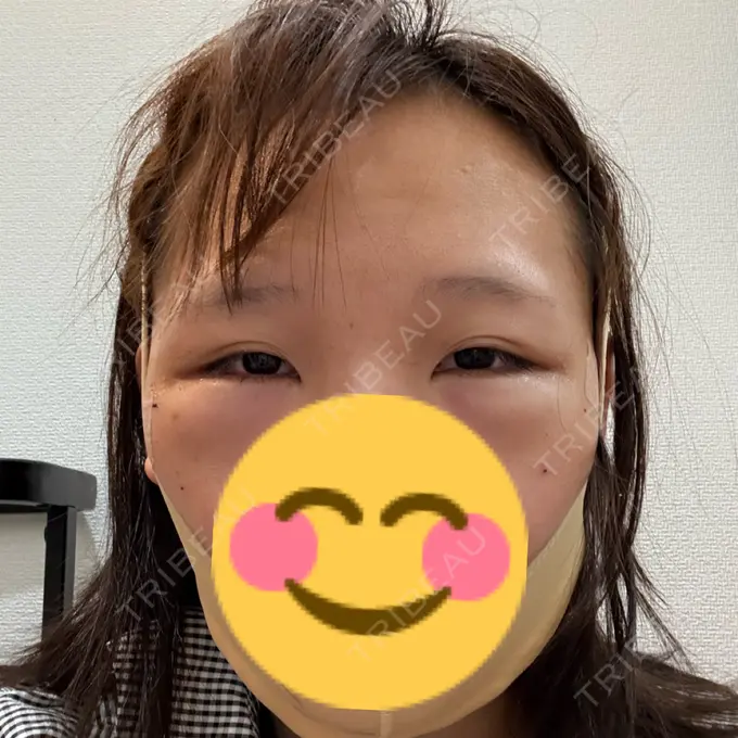 クマ治療 / 脂肪吸引（顔） / ボトックス（エラ・小顔） R Beauty CLINIC 銀座院 AFTER メイン用