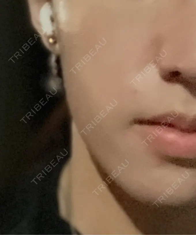 ボトックス（エラ・小顔） eクリニック 東京院 AFTER メイン用