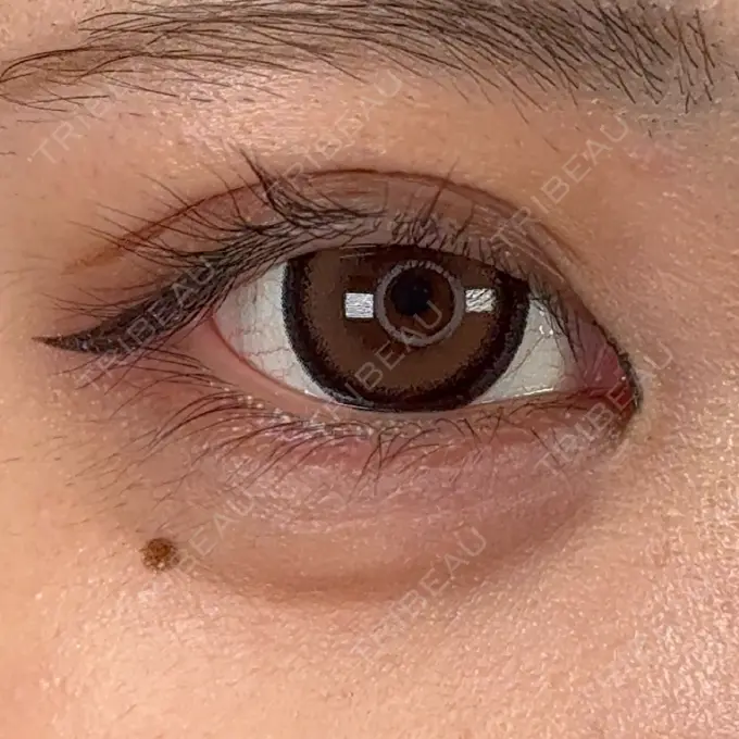 ヒアルロン酸注入（涙袋） / ヒアルロン酸注入（唇） / ボトックス（タレ目） アリエル美容クリニック 横浜院 AFTER メイン用