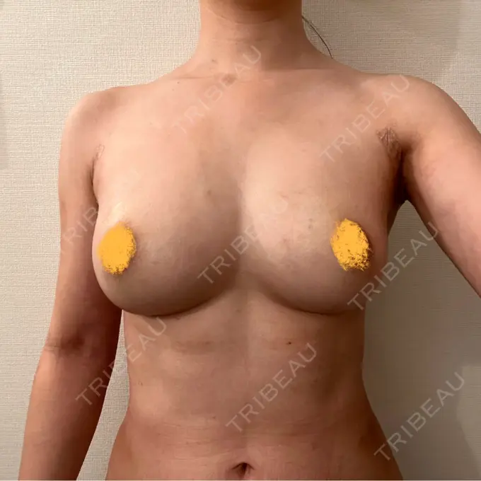 脂肪吸引（二の腕） / 豊胸（脂肪注入） / 脂肪吸引（腰） / 脂肪吸引（背中） / 脂肪吸引（肩） ICON CLINIC DAY 18 メイン用